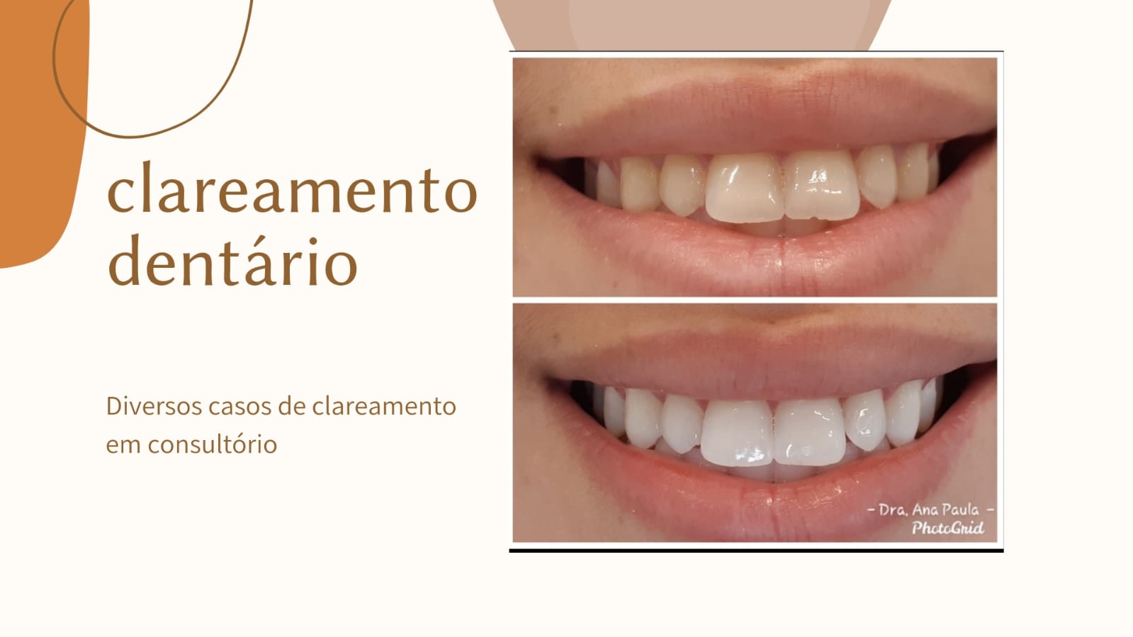 Clareamento dentário