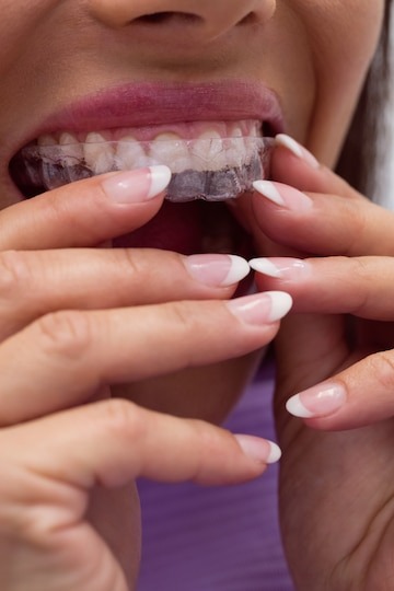 Invisalign