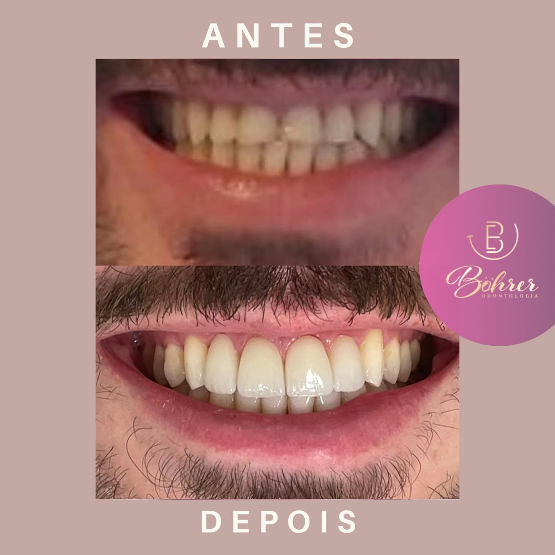 Lentes de contato